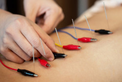 electroacupuncture
