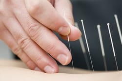 acupuncture in days creek, canyonville, tiller, winston, myrtle creek, roseburg